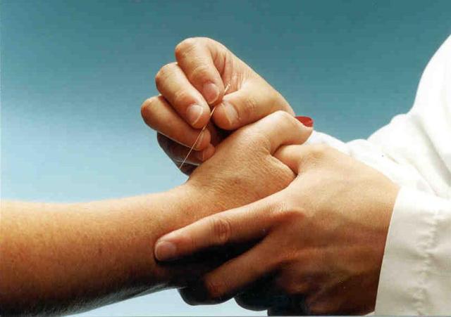 A closer look at acupuncture